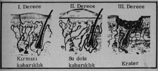 Yanık Çeşitleri Nelerdir? Yanık Çeşitleri Nelerdir?