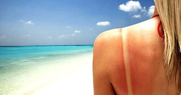 Yanık Lekesi Nasıl Geçer?